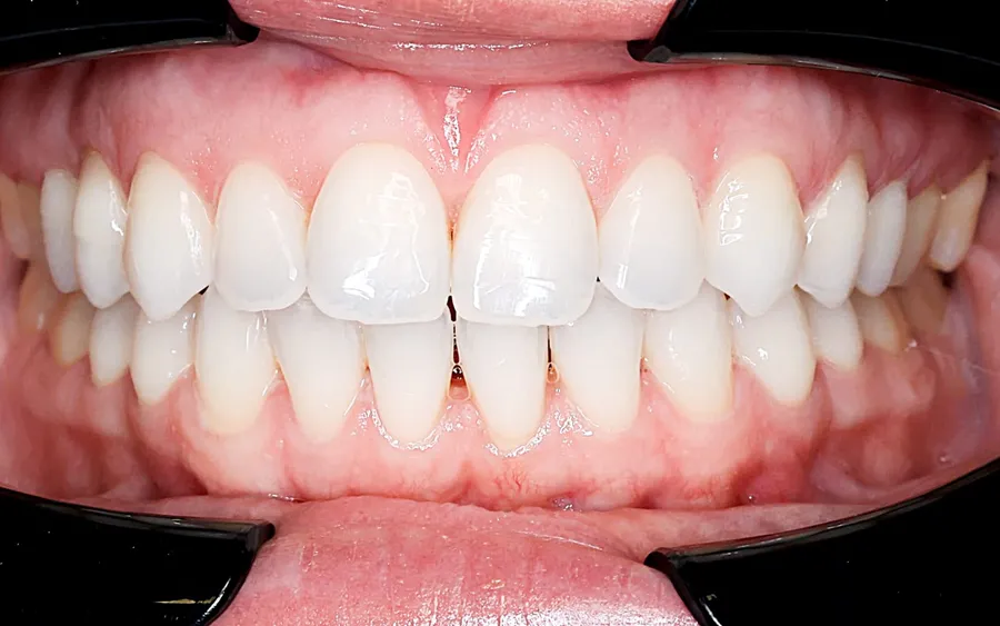 After treatment