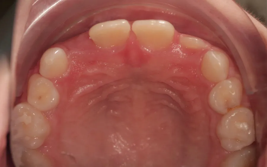 After treatment