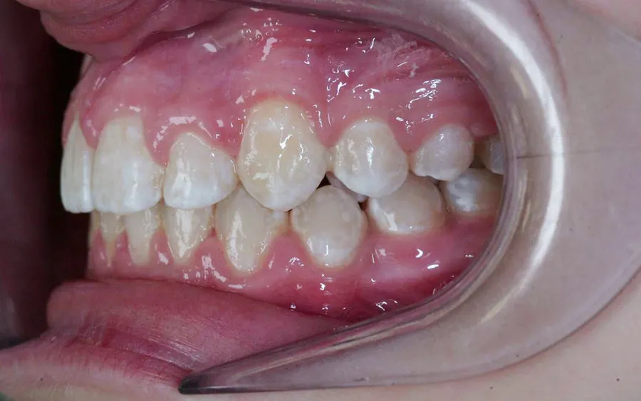 After treatment