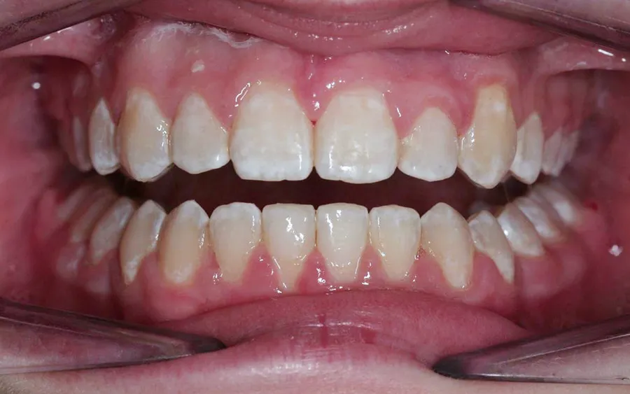 After treatment