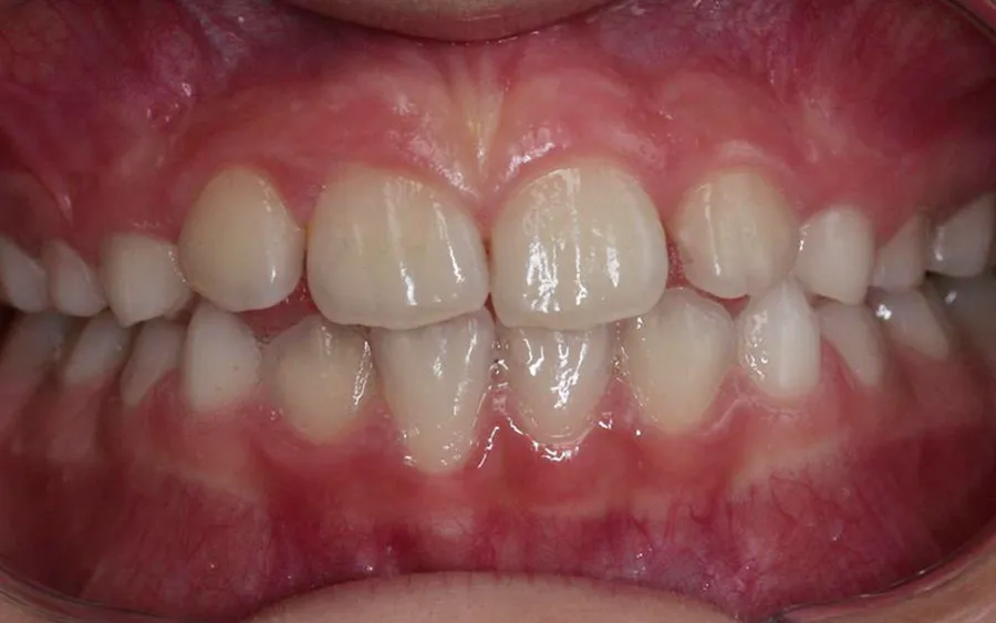 After treatment