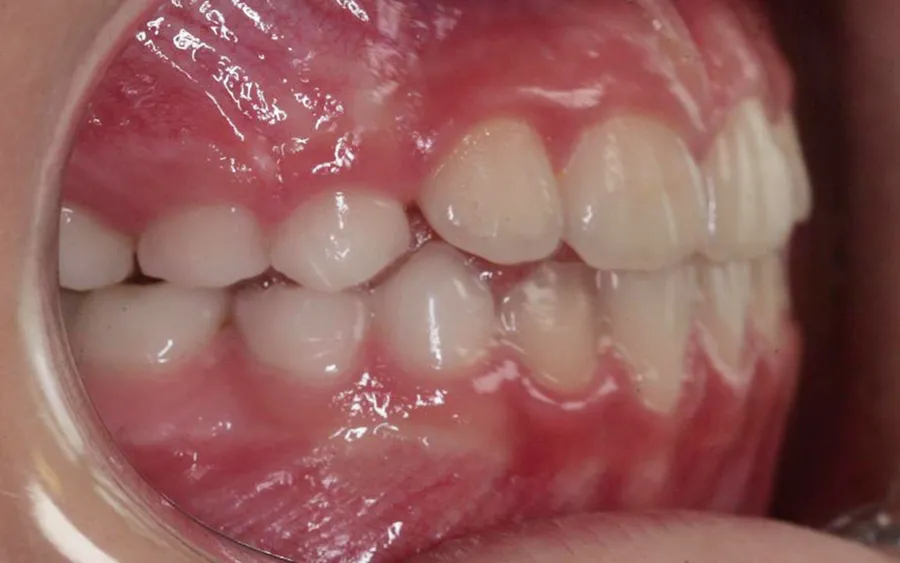 After treatment