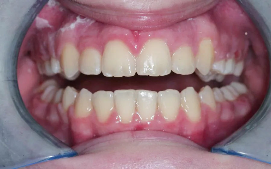 After treatment