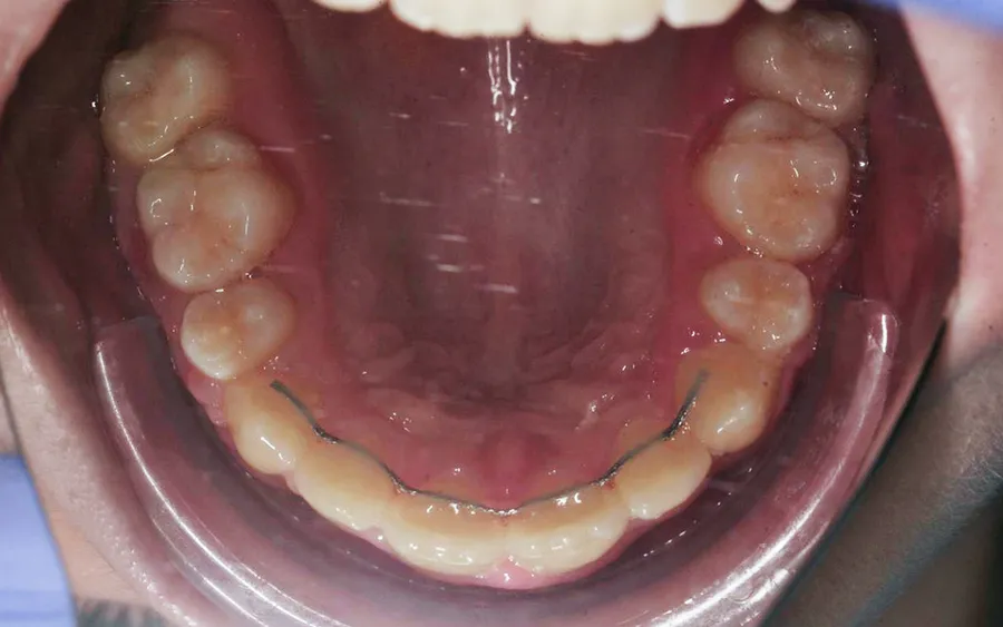 After treatment