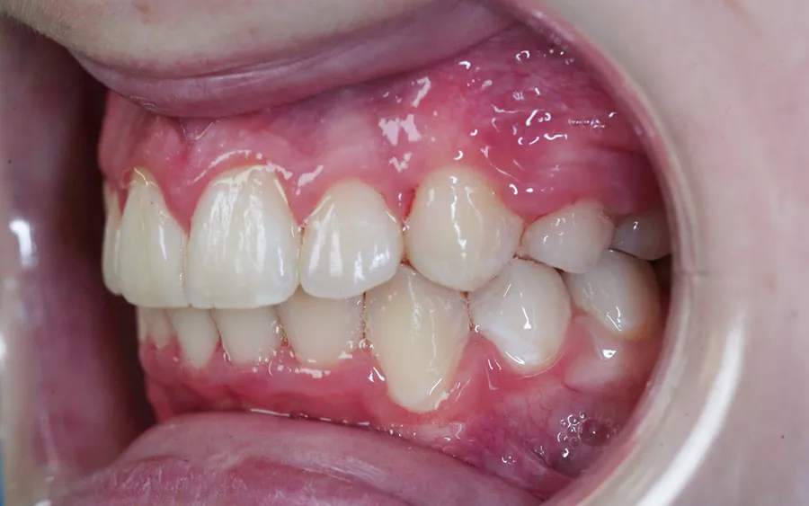 After treatment