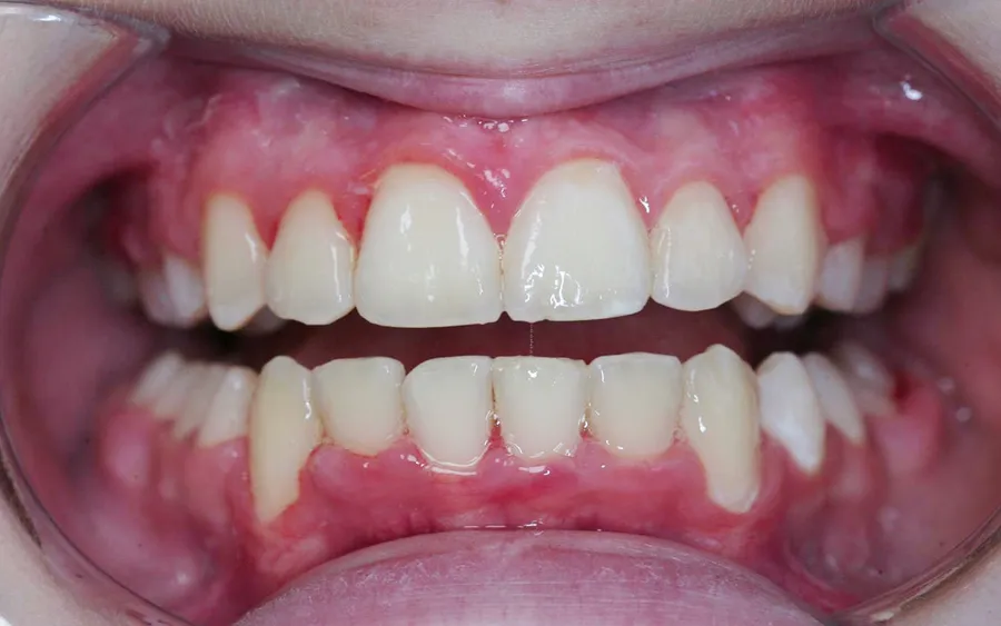 After treatment