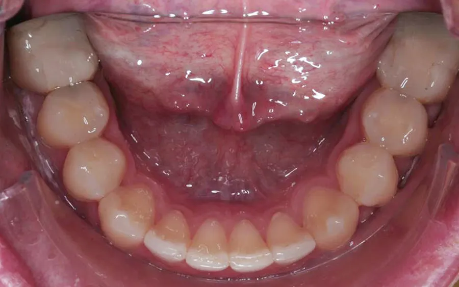 After treatment