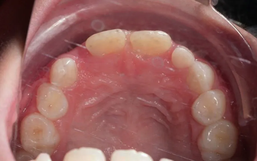 Before treatment