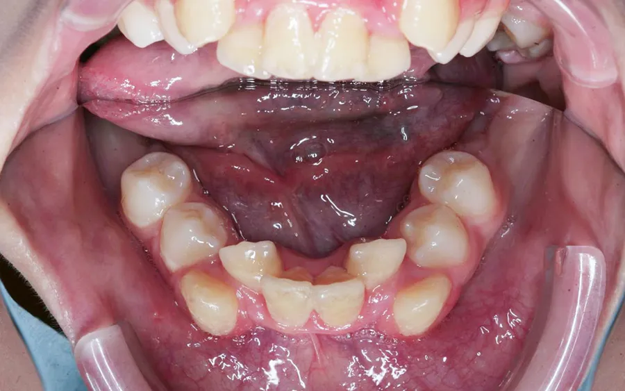 Before treatment