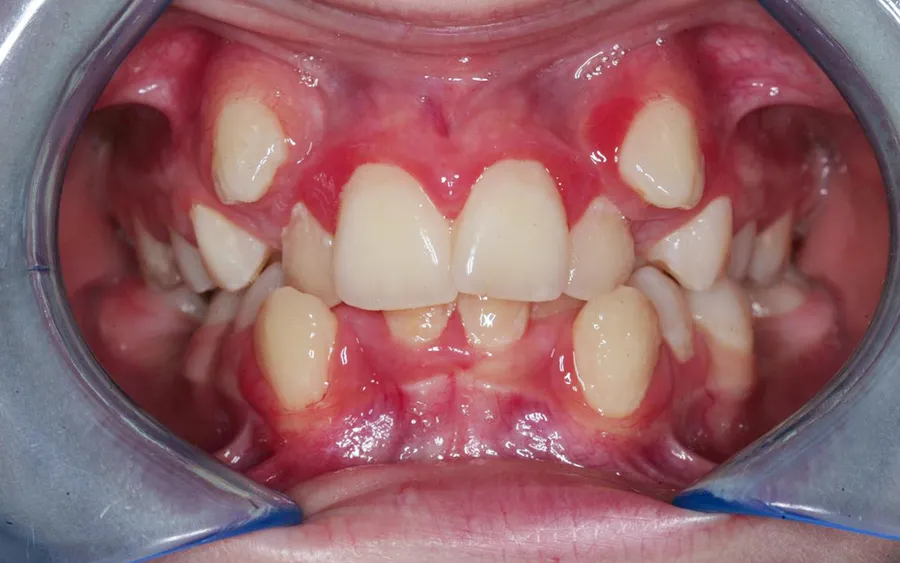 Before treatment