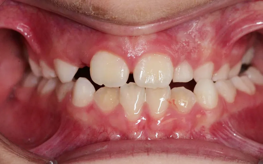 Before treatment