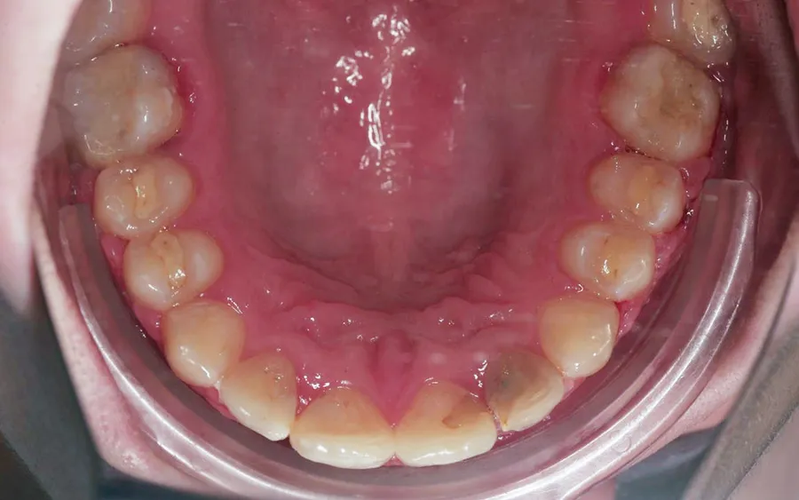 After treatment