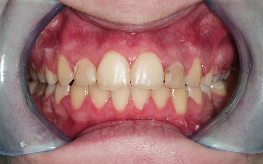 After treatment