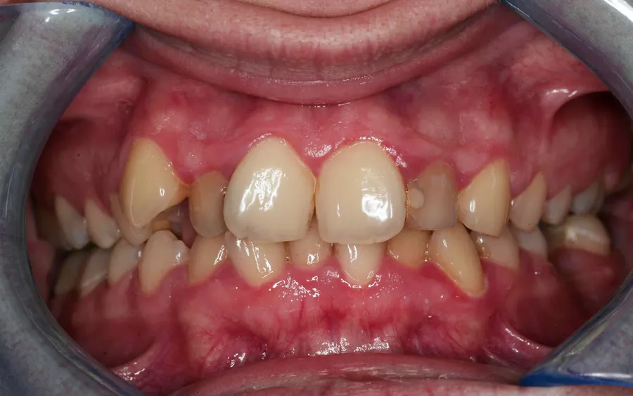 Before treatment