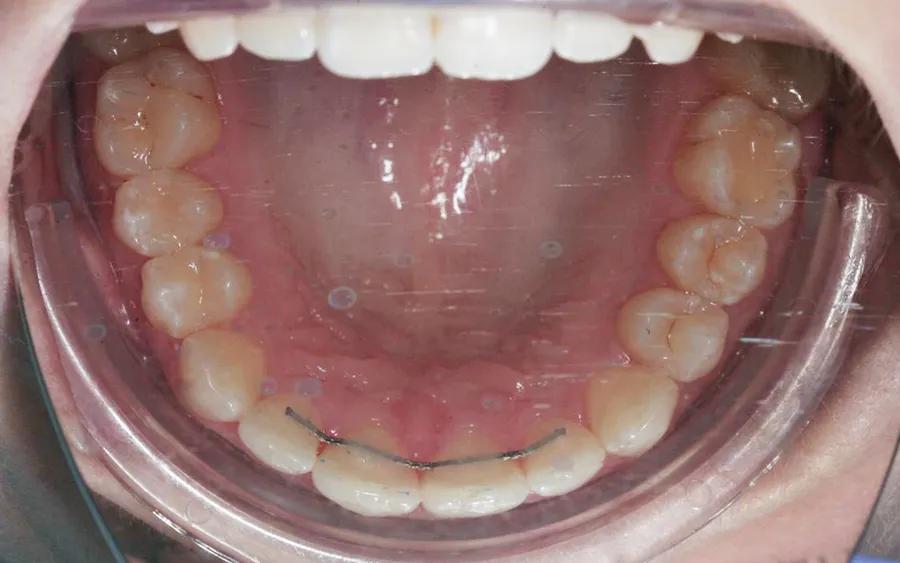 After treatment