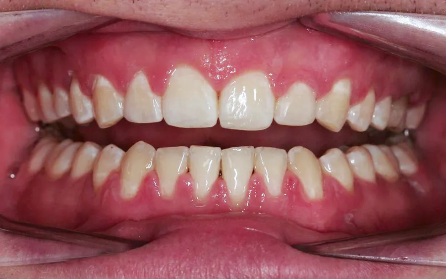 After treatment