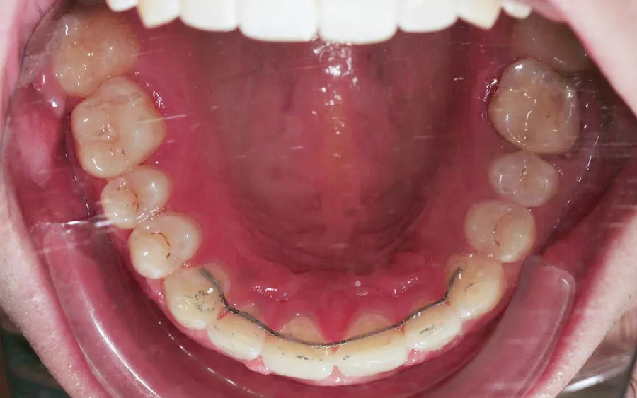 After treatment