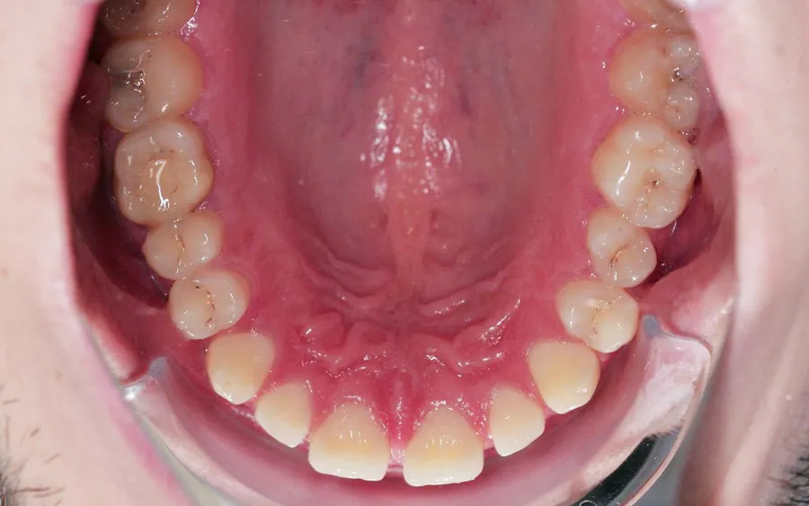 Before treatment